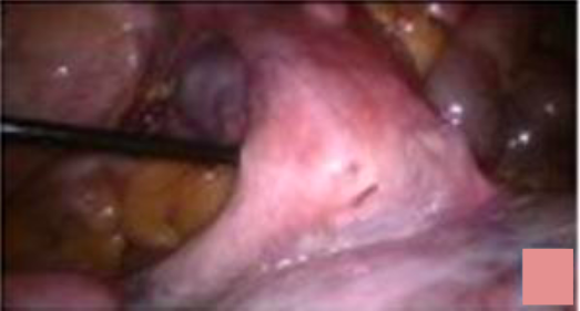 large uterine mass in abdominal cavity